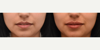 Lip Fillers before and after photo