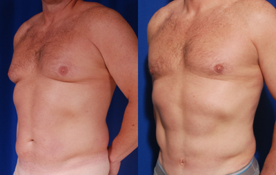 Abdominal Etching before and after photo