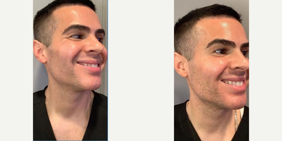 Dysport before and after photo