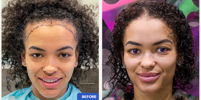 Forehead Reduction before and after photo
