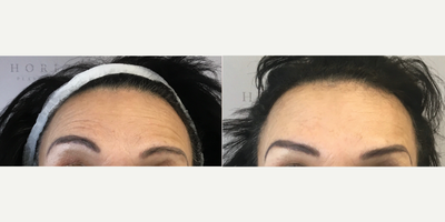 Botox before and after photo