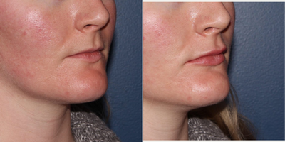 Juvederm before and after photo