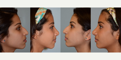 Rhinoplasty before and after photo