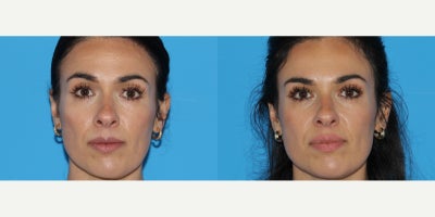 Botox before and after photo