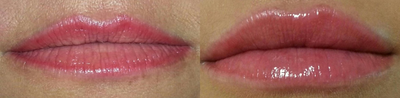 Dermal Fillers before and after photo