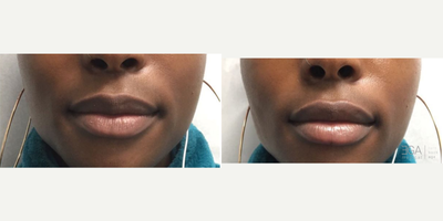 Lip Fillers before and after photo