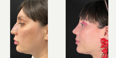 Rhinoplasty before and after photo