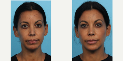Voluma before and after photo