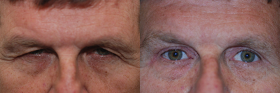 Brow Lift before and after photo
