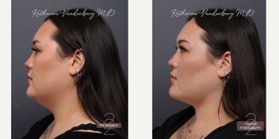 Chin Liposuction before and after photo