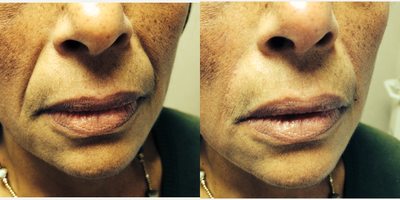Juvederm before and after photo