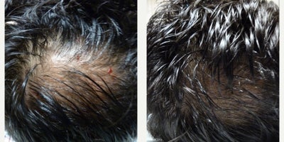 PRP for Hair Loss before and after photo
