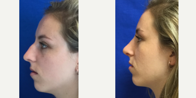 Rhinoplasty before and after photo