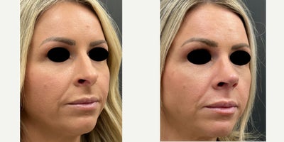 Rhinoplasty before and after photo
