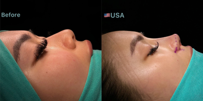 Asian Rhinoplasty before and after photo