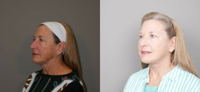 Deep Plane Facelift before and after photo