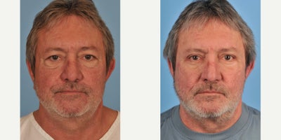 Eyelid Surgery before and after photo