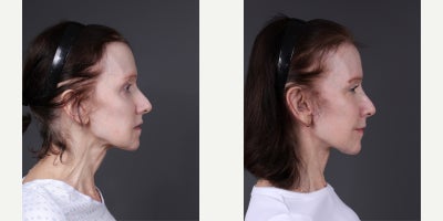 Facelift before and after photo