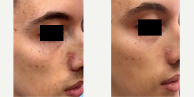IPL before and after photo