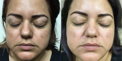 Microneedling before and after photo