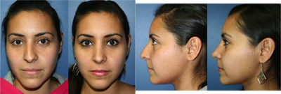 Rhinoplasty before and after photo