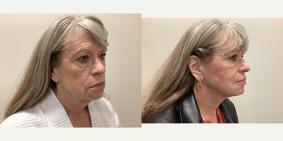 Neck Lift before and after photo
