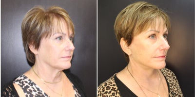 Neck Lift before and after photo