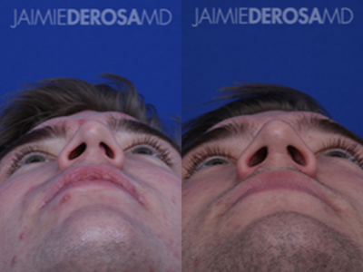 Rhinoplasty before and after photo