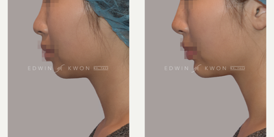 Chin Filler before and after photo