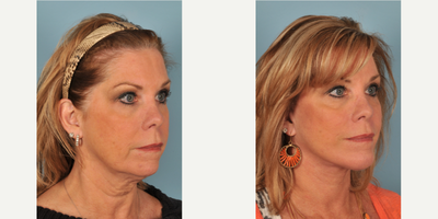 Chin Implant before and after photo