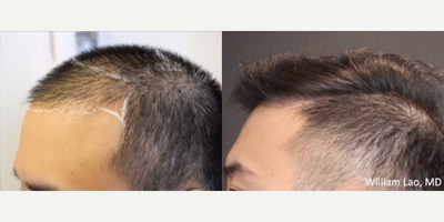 Hair Transplant before and after photo