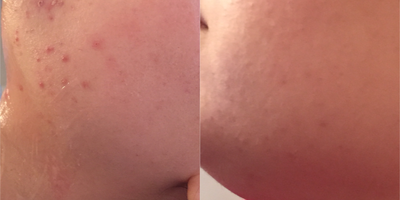 Pelleve before and after photo