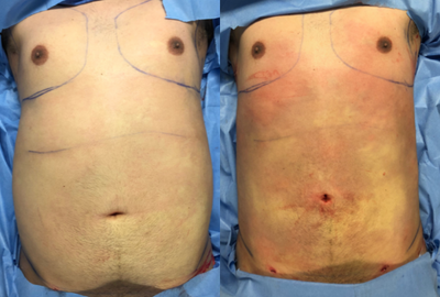 Tummy Tuck before and after photo