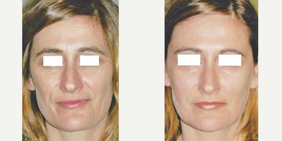 Botox before and after photo