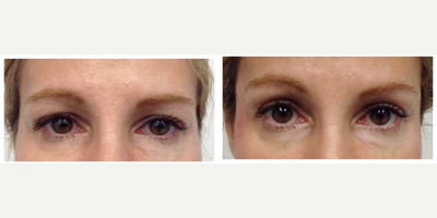 Dermal Fillers before and after photo
