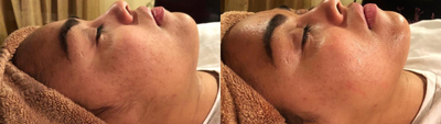 Dermaplaning before and after photo