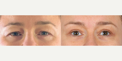 Eyelid Surgery before and after photo