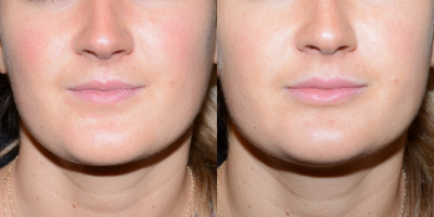 Lip Fillers before and after photo