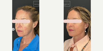 Lower Facelift before and after photo