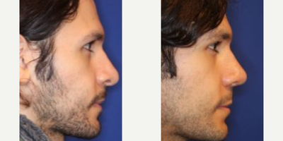 Rhinoplasty before and after photo