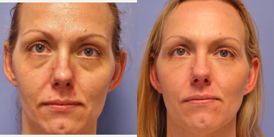 Bellafill before and after photo