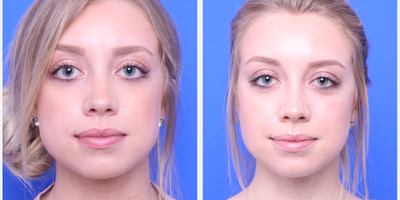 Buccal Fat Removal before and after photo