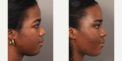 Eyelid Surgery before and after photo