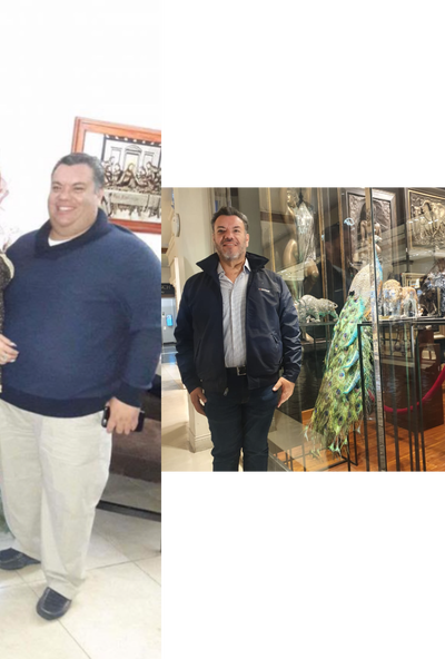 Gastric Sleeve Surgery before and after photo
