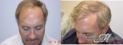 Hair Transplant before and after photo