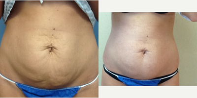 Profound RF before and after photo