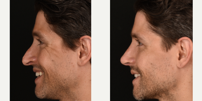 Revision Rhinoplasty before and after photo