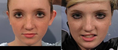 Ear Surgery before and after photo