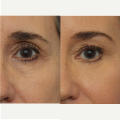 Eyelid Surgery before and after photo