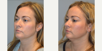 Facial Fat Transfer before and after photo